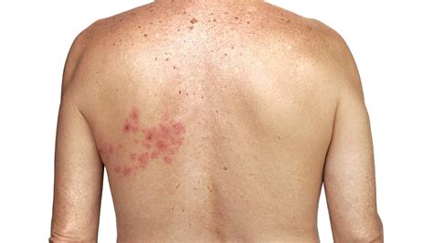 Bältros (herpes zoster): orsak, symptom och behandling